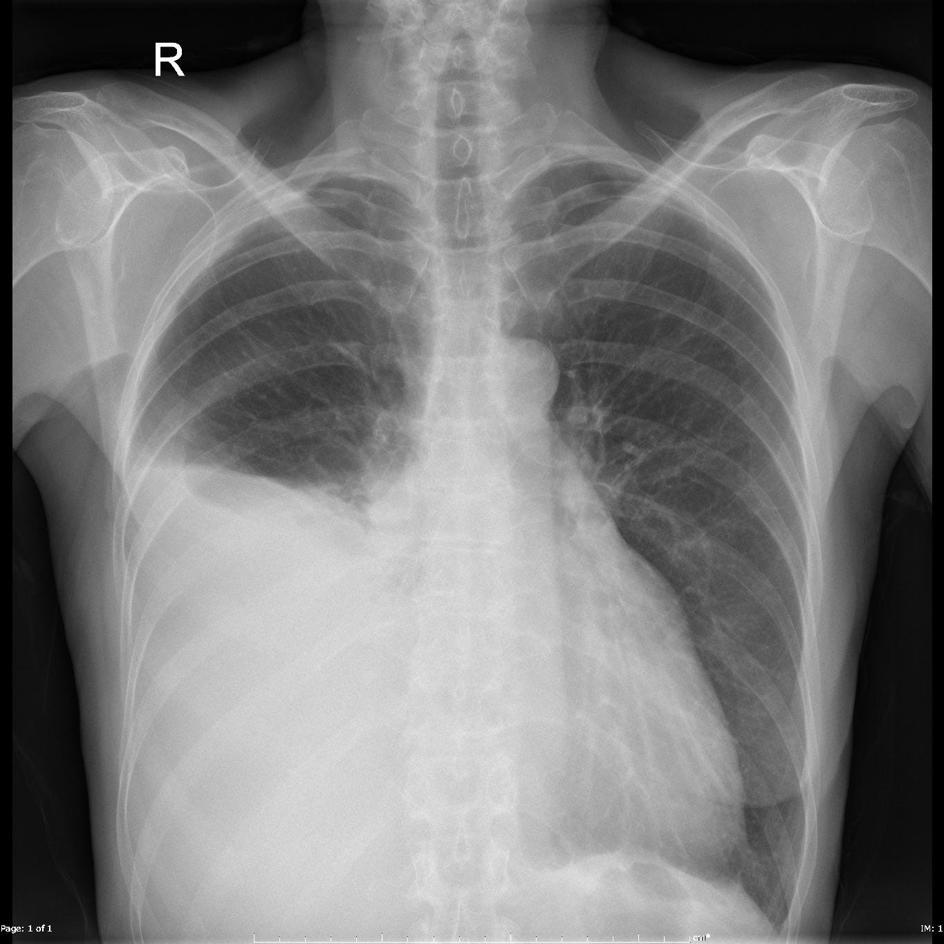 pleural-effusion-unilateral-malignant